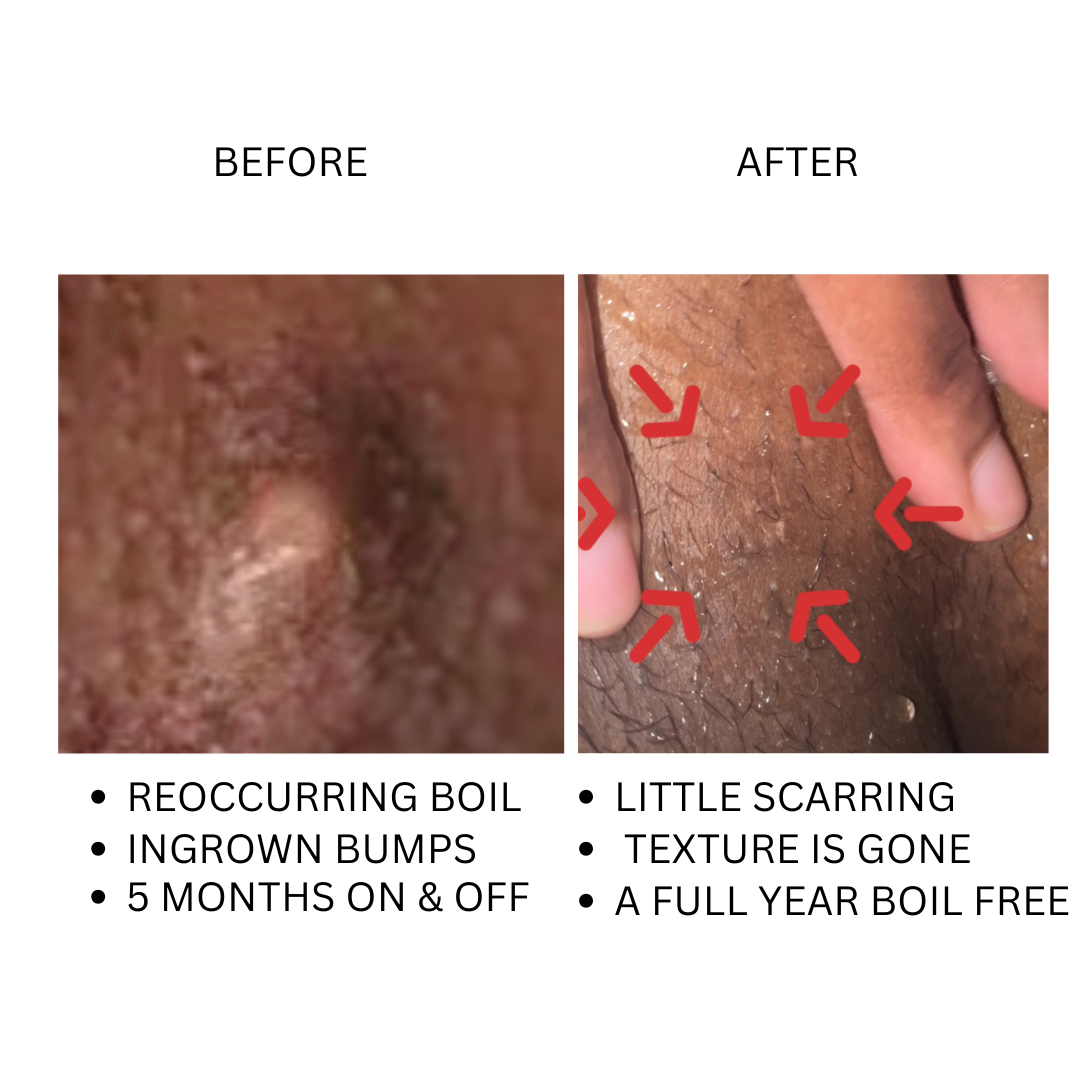 SALICYLIC + BLUE TANSY SERUM BIKINI ACNE, BOILS, HIDRADENITIS SUPPUARATIVA image 1